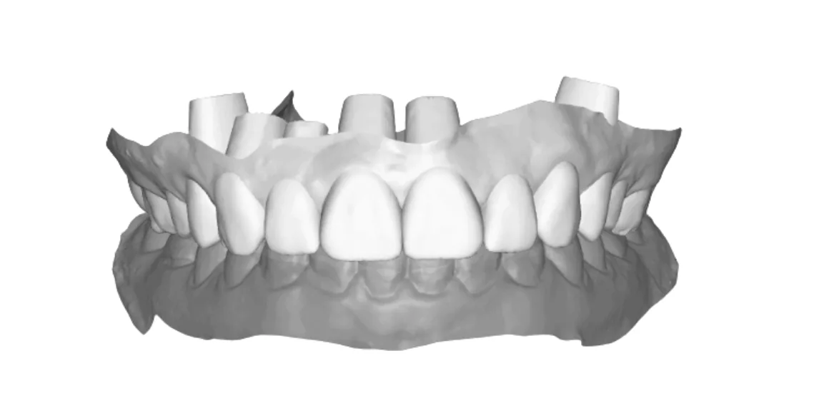 Análise tomográfica no planejamento periodontal