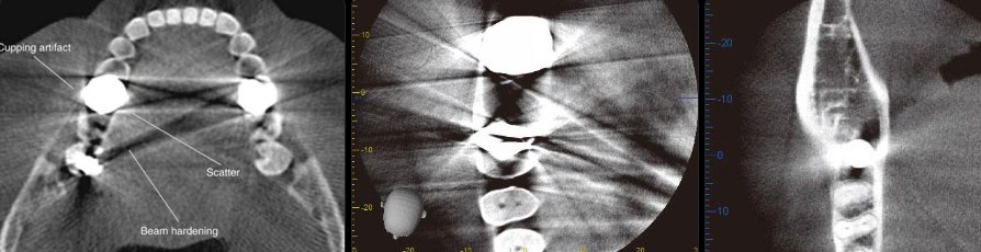 Artefato de endurecimento de feixe em tomografia odontológica