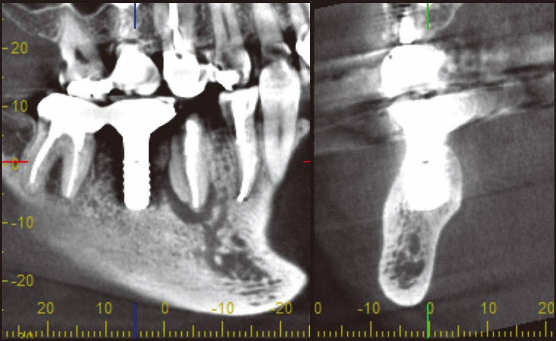 Artefato em tomografia odontológica: por que a imagem do seu paciente está ruim