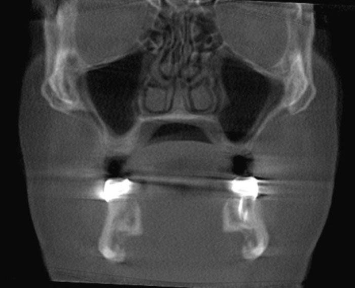 Artefato de movimento em tomografia odontológica