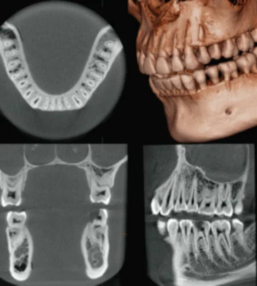 Acurácia diagnóstica da tomografia CBCT
