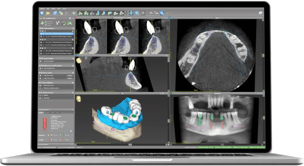 Software de planejamento digital com tomografia
