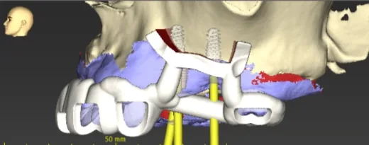 Implantes guia cirúrgica