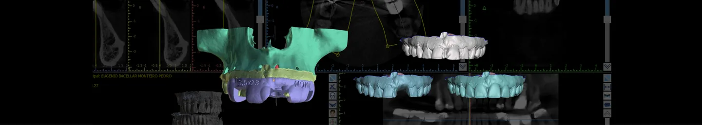 Importância do Implantodontista dominar o fluxo digital da tomografia