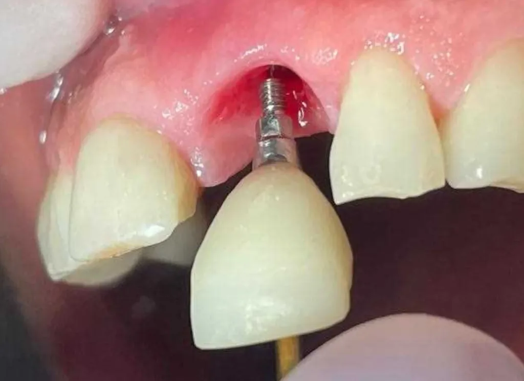 Implante dental