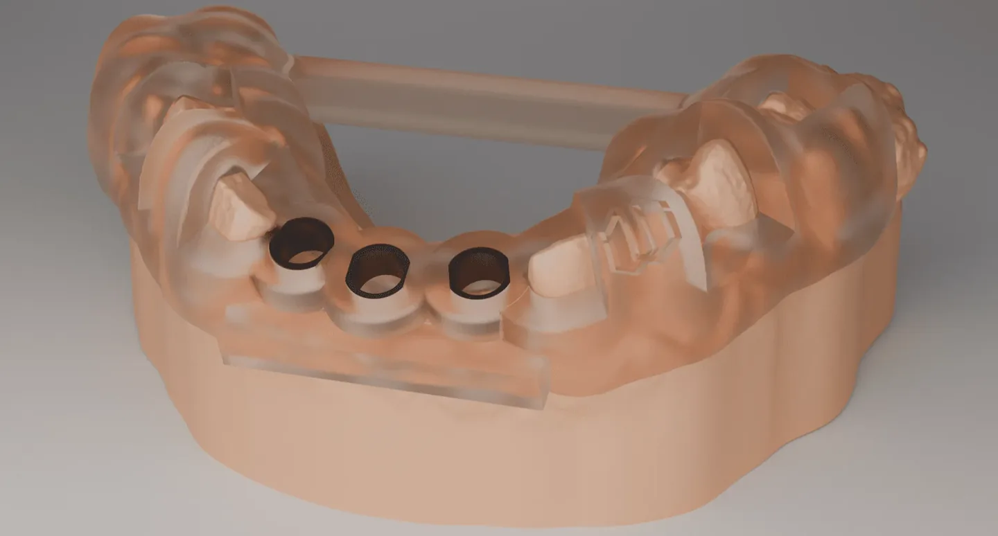 Guia cirúrgica impressa em 3D