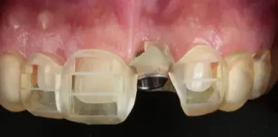 Guia cirúrgica para implantes