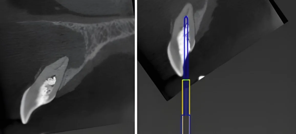 Indicações clínicas da endodontia guiada