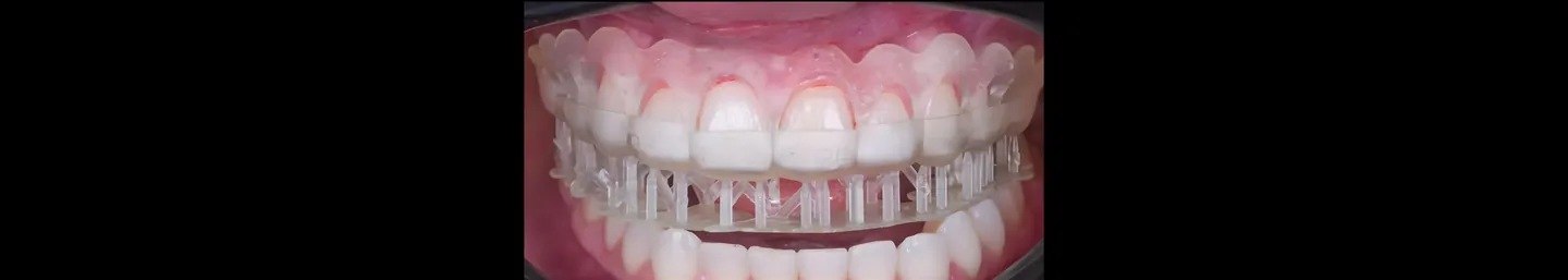 Perioguide: o guia cirúrgico que transforma o tratamento do sorriso gengival