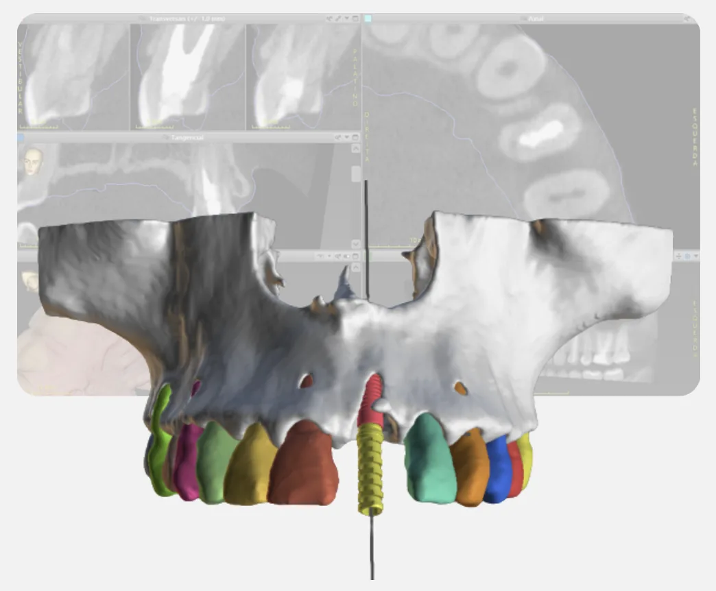Reconstrução 3D de tomografia odontológica para planejamento de implante