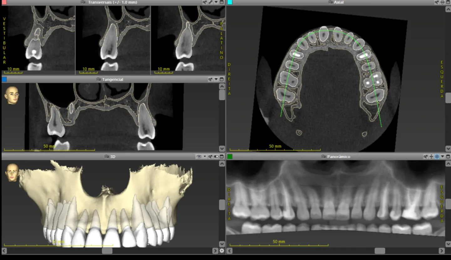 Tomografia computadorizada de feixe cônico (CBCT)