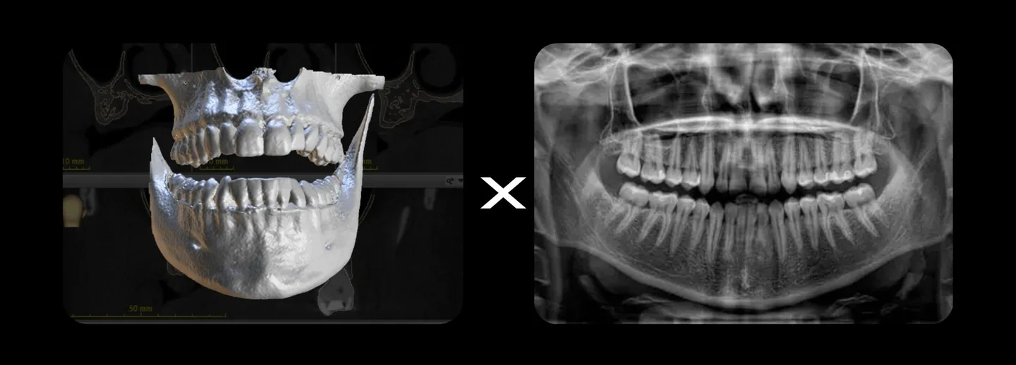 Tomografia Computadorizada x Radiografia Panorâmica na Odontologia