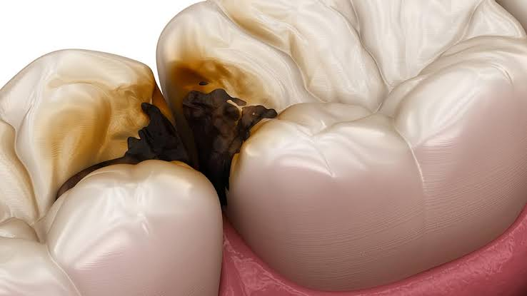 Radiografia interproximal evidenciando lesões de cárie nas faces proximais