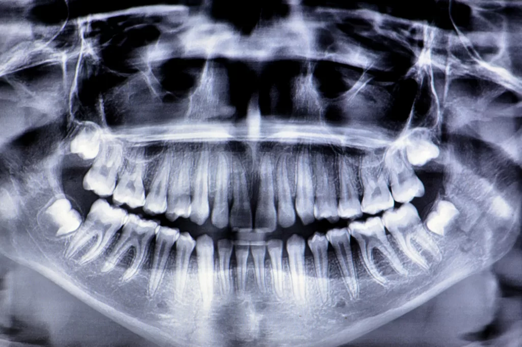 Comparação entre lesão restrita ao esmalte e lesão em dentina