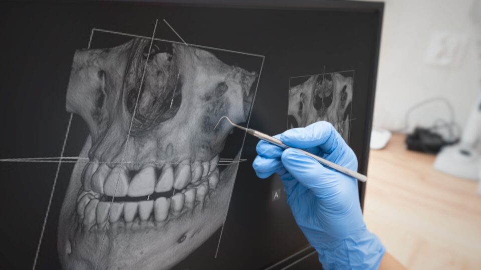 Guia cirúrgico posicionado durante a osteotomia