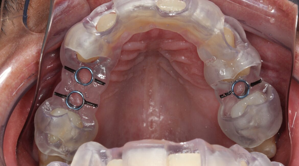 Cirurgia guiada: em que casos ela compensa e em que casos não