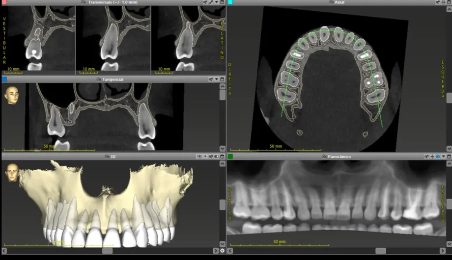Tomografia aberta no software, com os cortes transversal, axial, tangencial, a reconstrução 3D e a panorâmica