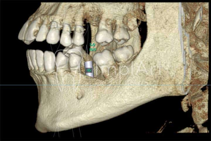 Tomografia odontológica de feixe cônico